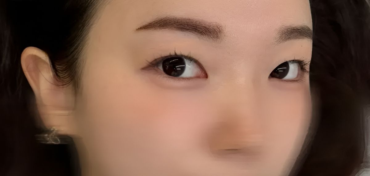 모노피그먼트 시술 장면