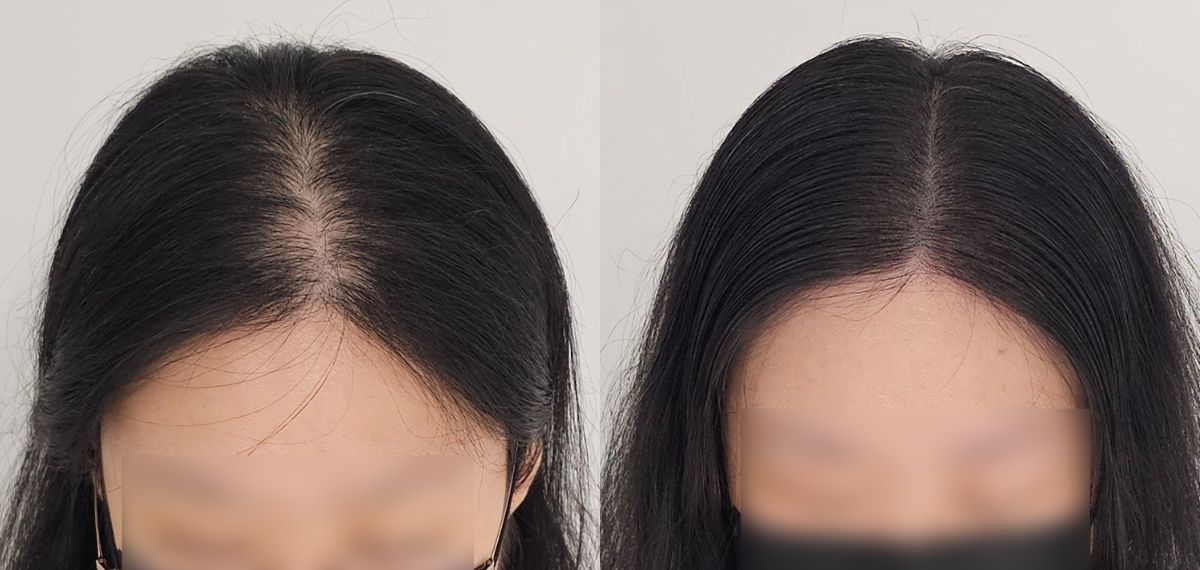 모노피그먼트 시술 장면