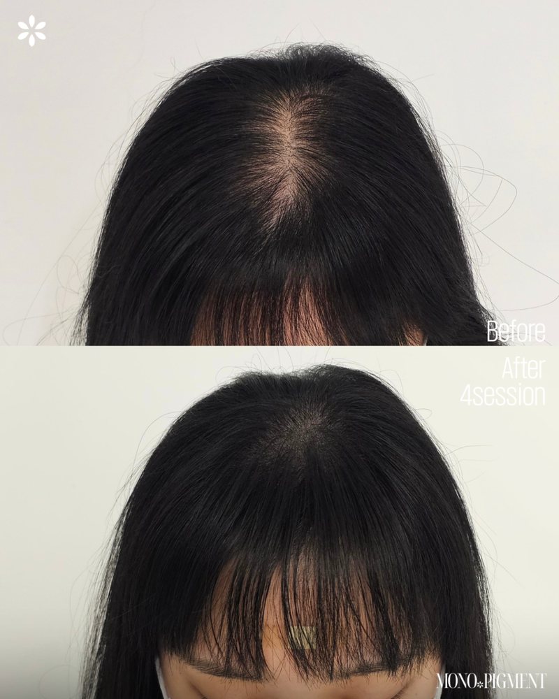 SMP 정수리 시술 전후
