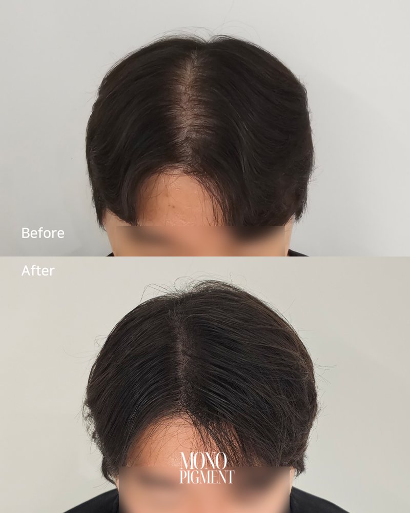 SMP 남자 정수리 시술 전후 2