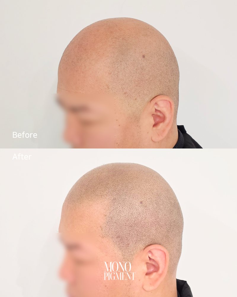 SMP 삭발 시술 전후