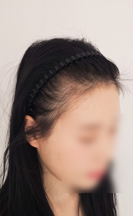 모노피그먼트 시술 장면