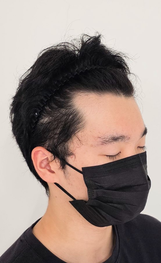 모노피그먼트 시술 장면