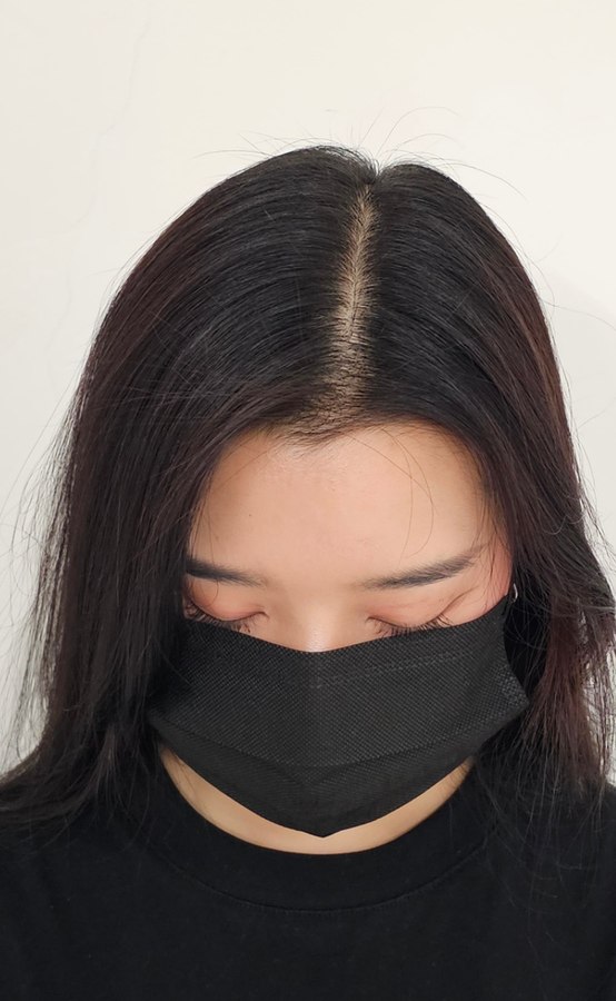 모노피그먼트 시술 장면