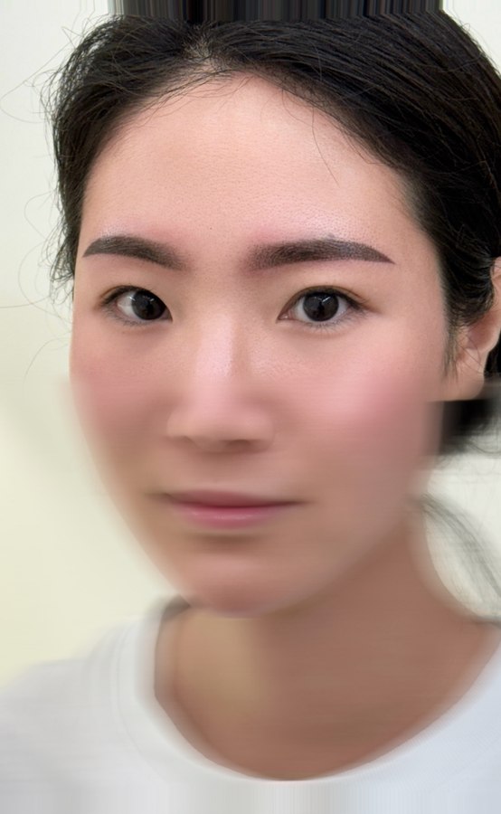 모노피그먼트 시술 장면