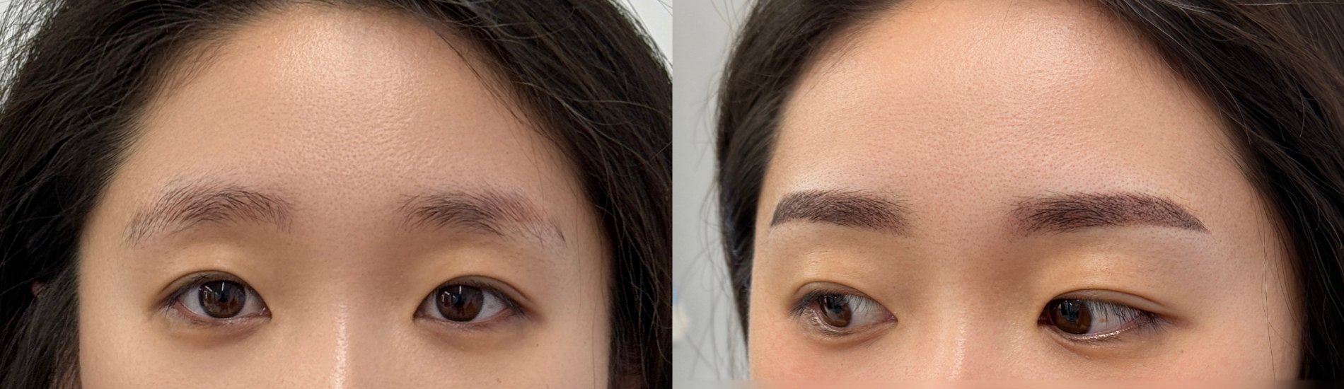 본 시술 1회